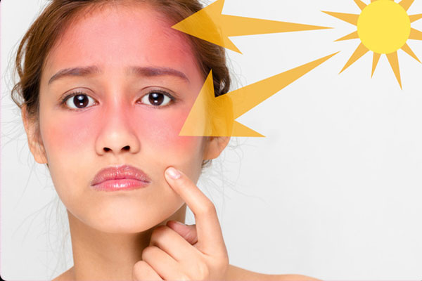 Lactic acid sẽ khiến da của bạn nhạy cảm hơn với ánh nắng mặt trời